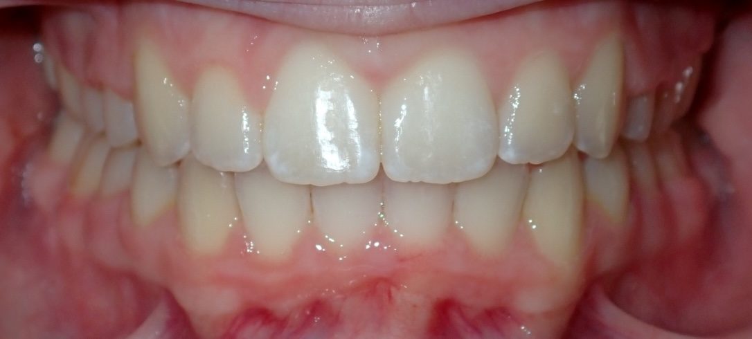 Featured orthodontic smile transformation